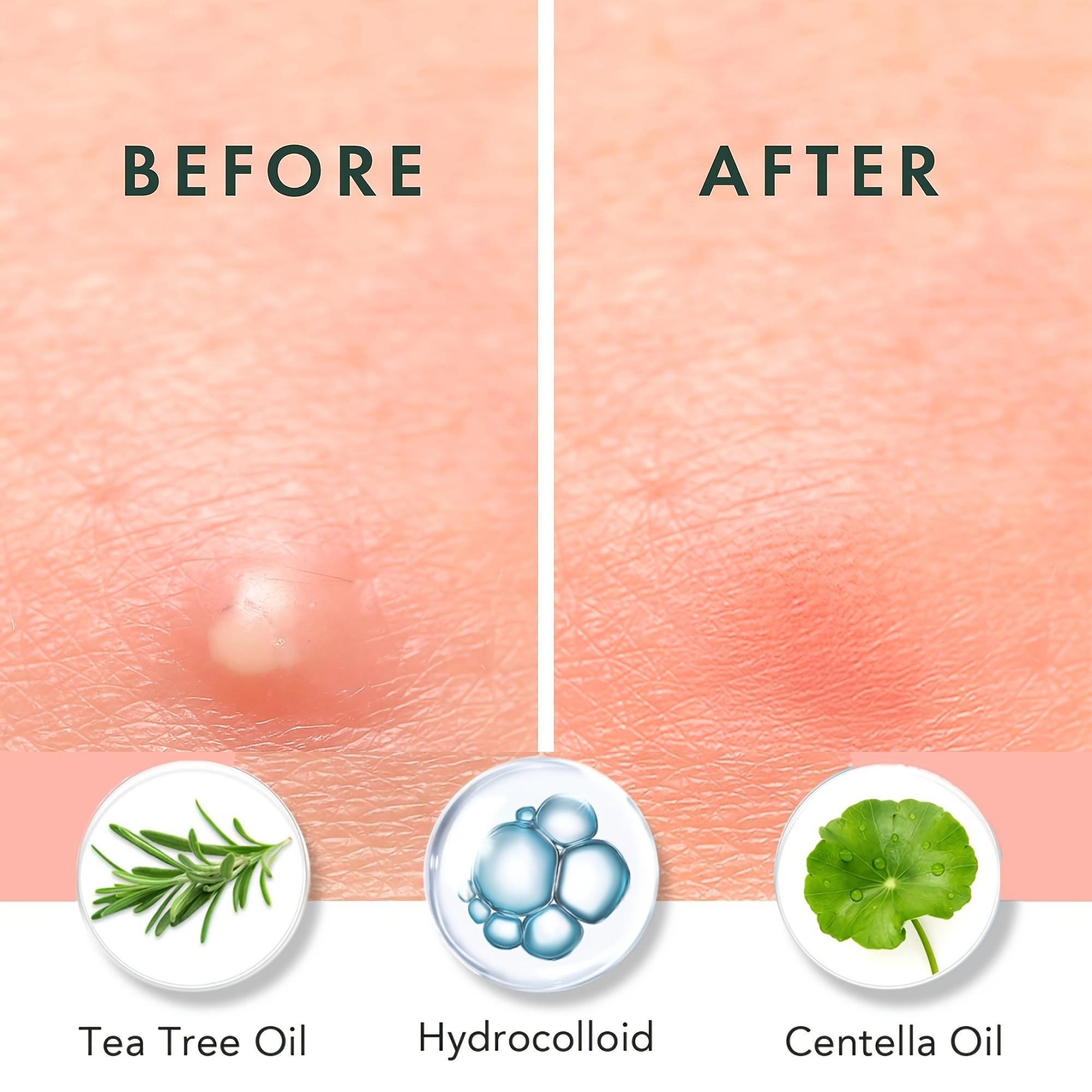 180/360/720 parches para el ac - Skincare Oil Control reseña y precio